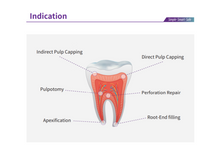 Load image into Gallery viewer, EndoCem Premix MTA