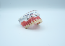 Load image into Gallery viewer, 4 Implant Upper Overdenture Jaw Model
