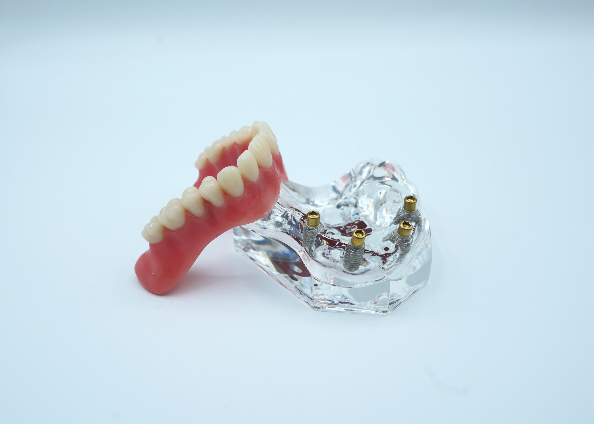 4 Implant Upper Overdenture Jaw Model