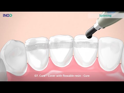 UP Fiber Splint – KB Dental Products